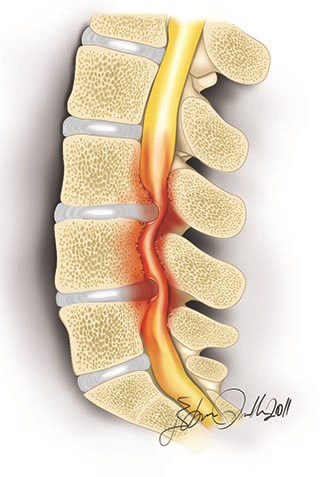 http://m.ahmetalanay.com/Resources/ArticleImage/ImageFileEn/lumbar-spinal-stenosis-narrow-canal-2_m.jpg