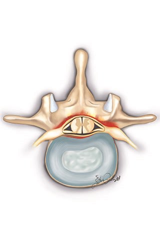 http://m.ahmetalanay.com/Resources/ArticleImage/ImageFileEn/lumbar-spinal-stenosis-narrow-canal-3_m.jpg