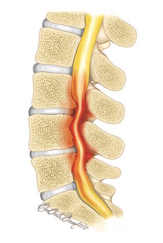 Lumbar Spinal Stenosis (Narrow Canal), Adult Spinal Disorders, Adults