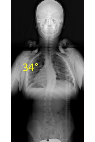 Thoracoscopic Anterior Tethering  Spinal Surgeries in Children