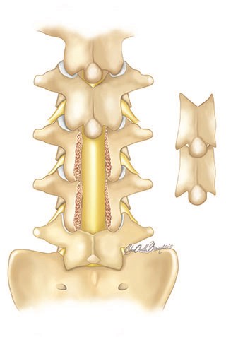 http://m.ahmetalanay.com/Resources/ArticleImage/ImageFileEn/treatment-of-lombar-spinal-stenosis-2_m.jpg