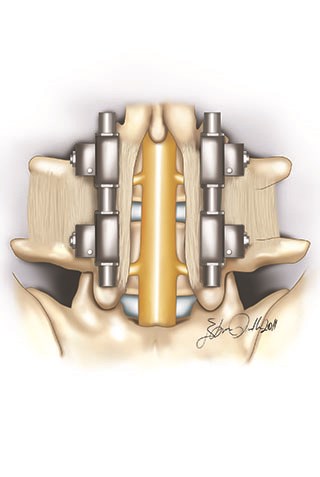 http://m.ahmetalanay.com/Resources/ArticleImage/ImageFileEn/treatment-of-lombar-spinal-stenosis-5_m.jpg