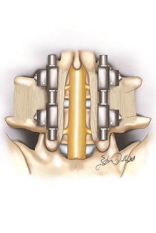 Lumbar Spinal Stenosis (Narrow Canal), Adult Spinal Disorders, Adults